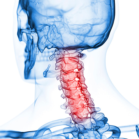 Image showing the neck vertebrae where pain occurs 